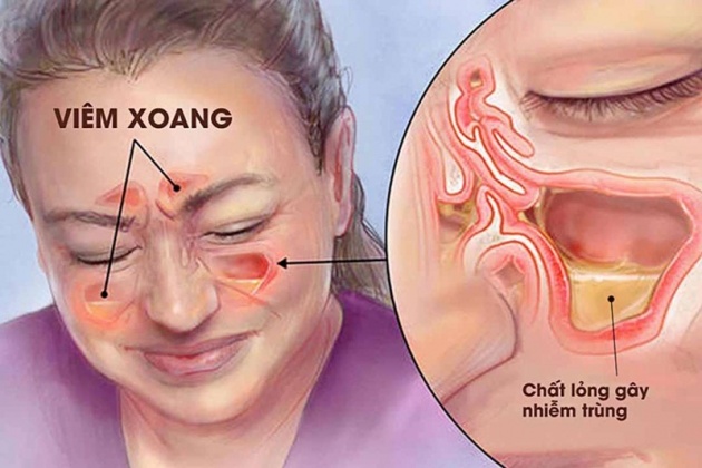 Viêm xoang có gây khó thở không? Nguyên nhân & Cách xử lý